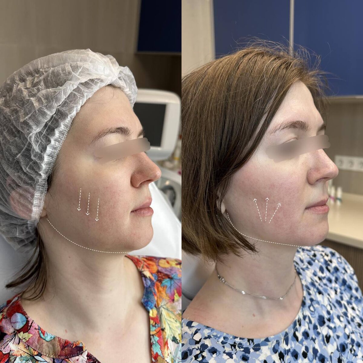 Реальное фото пациентки Клиники эстетической медицины «Гельтек»