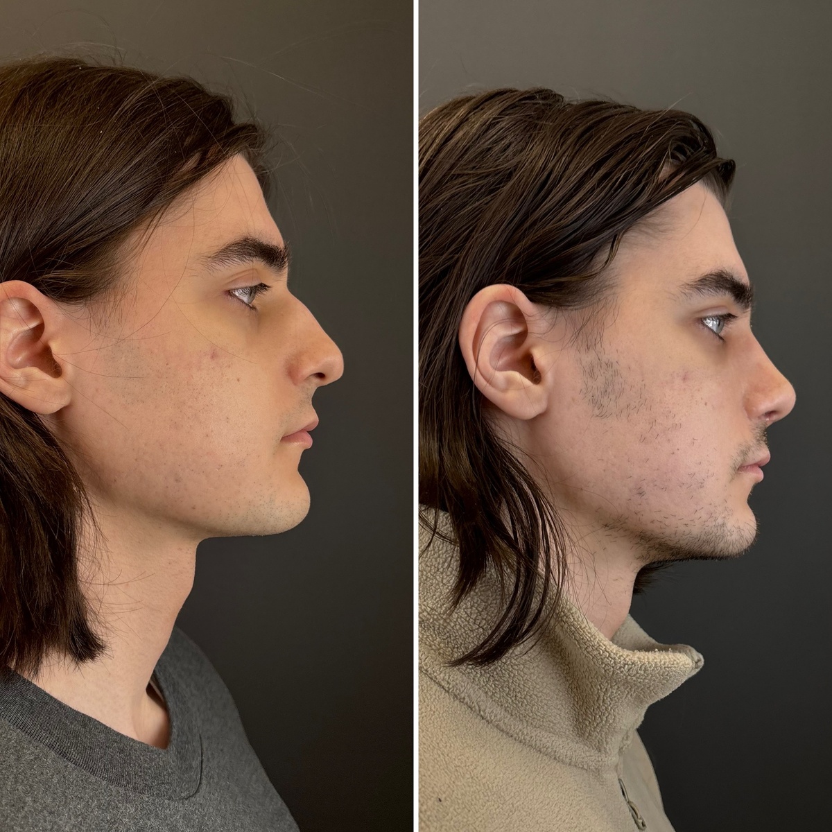 Риносептопластика: слева- до, справа- после. Хирург Остринская Т. В.