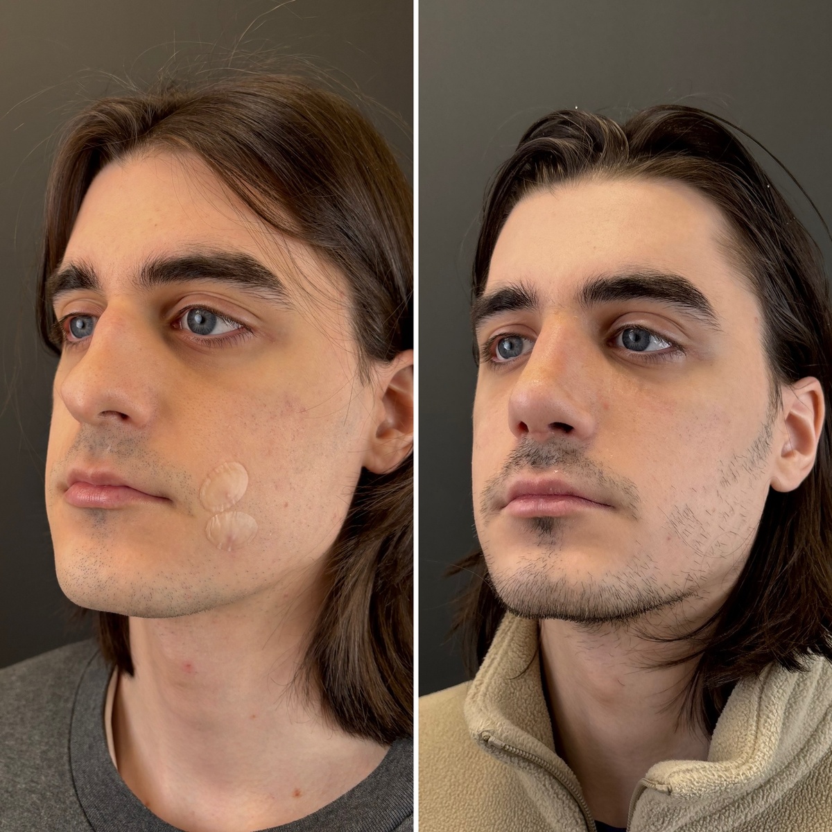 Риносептопластика: слева- до, справа- после. Хирург Остринская Т. В.