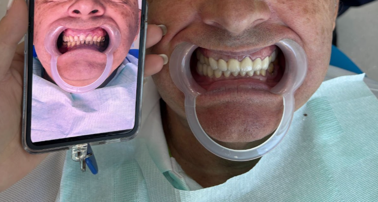 Фото зубов после Китая ― мужчина, 62 года