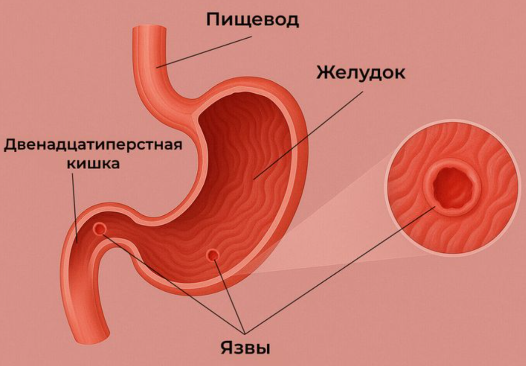 Слизистая оболочка желудка защищена от агрессивного действия соляной кислоты и пищеварительных ферментов. Когда этот защитный барьер нарушается, кислота начинает повреждать поверхностные клетки. Постепенно дефект углубляется, и формируется язва. Часто в процесс вовлекается и двенадцатиперстная кишка.