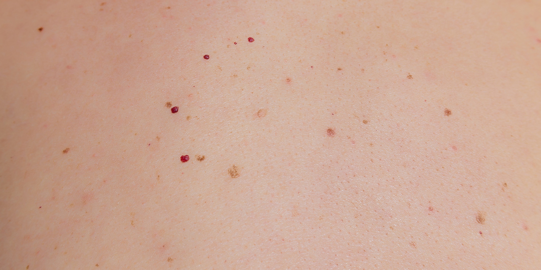 Появились мелкие красные точки — что это может быть