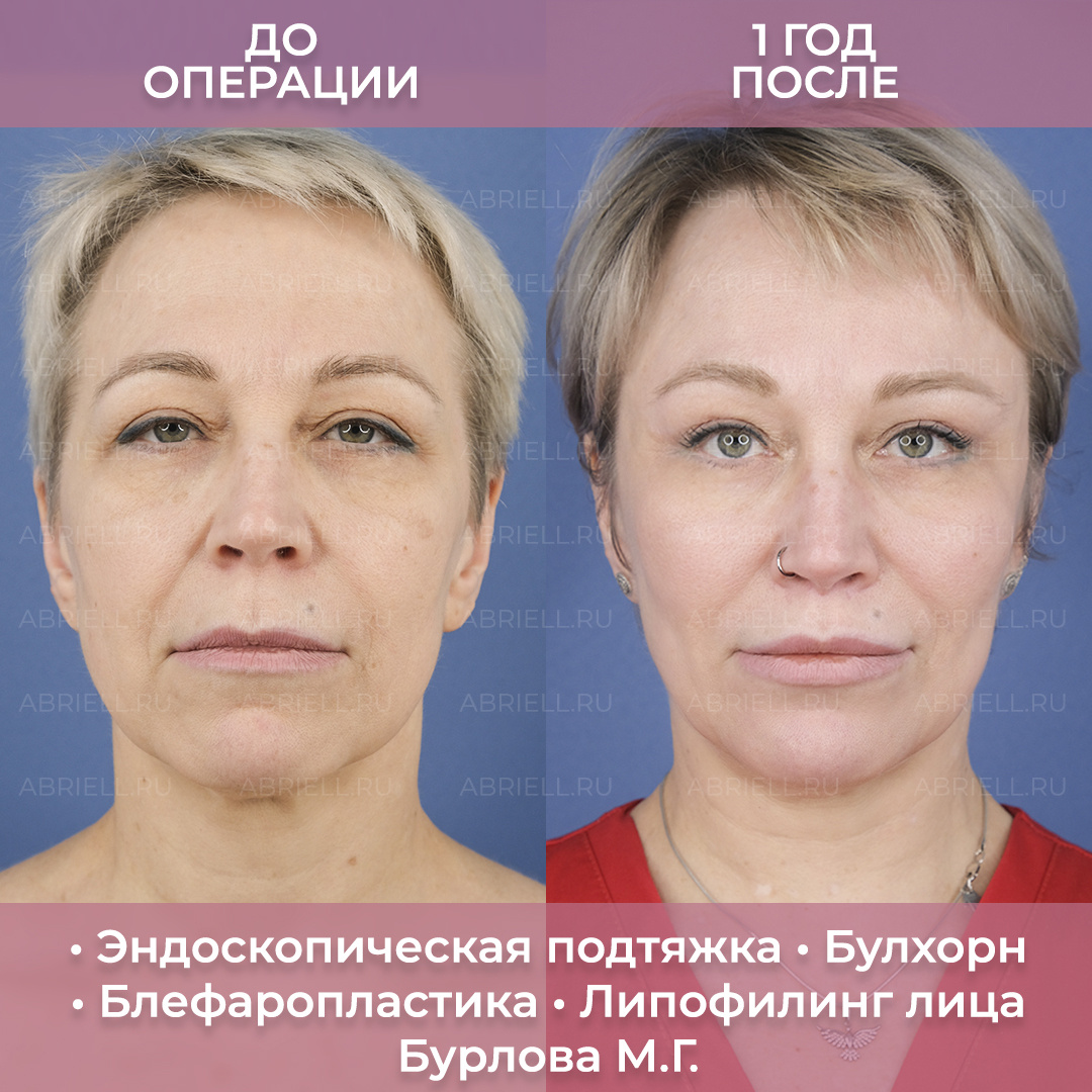 Комплексное омоложение / Подтяжка лица результат до после / Бурлова Мария Григорьевна Пластический хирург СПб