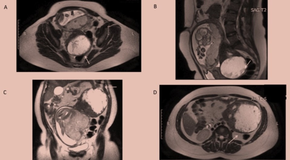   Rosalba De Nola et al. / BMJ Case Reports, 2026