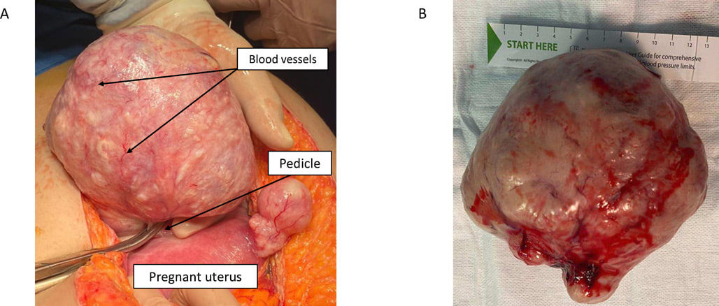   Rosalba De Nola et al. / BMJ Case Reports, 2026