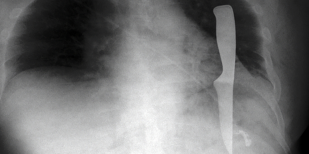 В Первой градской больнице в легком мужчины нашли кухонный нож