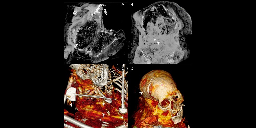    КТ детских останков с вулкана Сара-Сара. / Фото: Journal of Archaeological Science: Reports