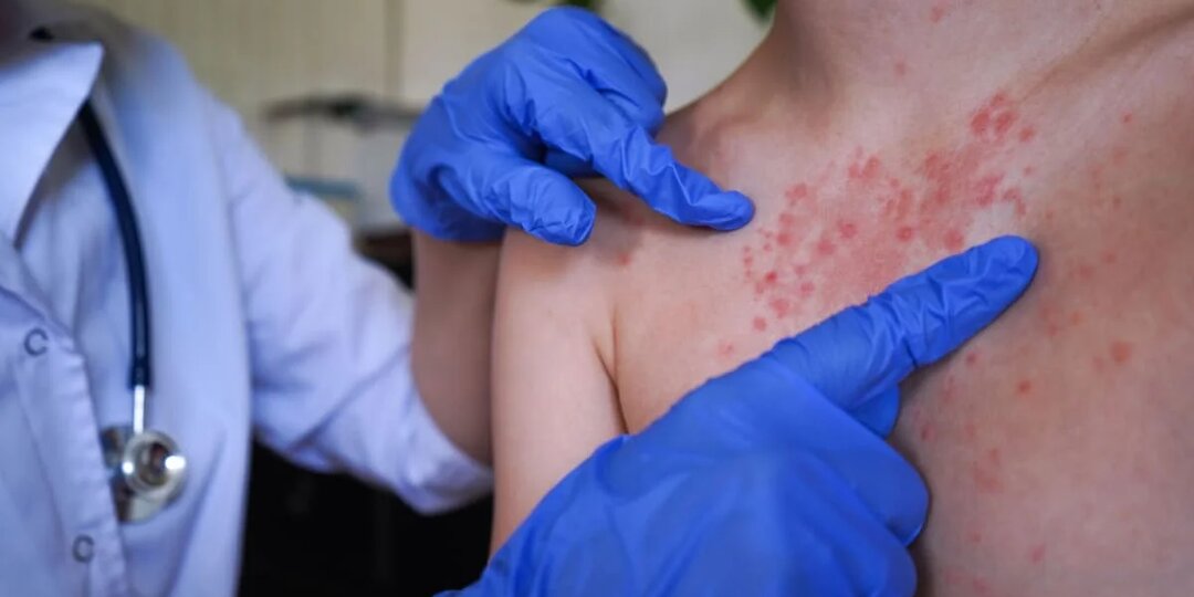 Корь у детей в Казахстане: санврачи обратились к родителям