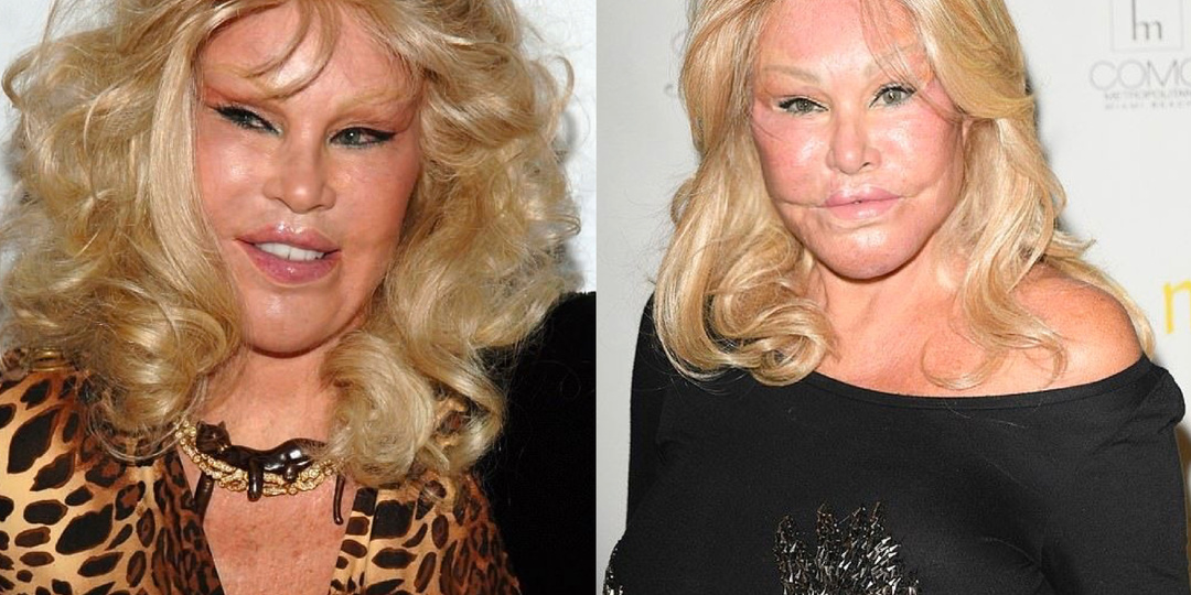 Они сделали ЭТО слишком рано: как уколы и операции сломали лица звёзд