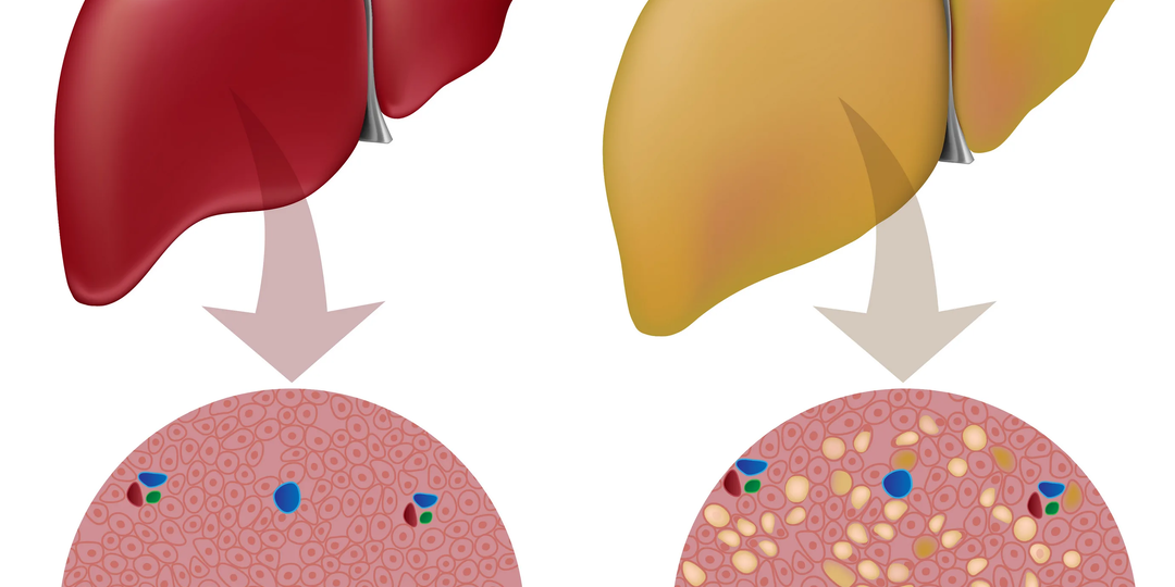 «Откуда у меня жировая болезнь печени?» — разбираем частый вопрос пациентов