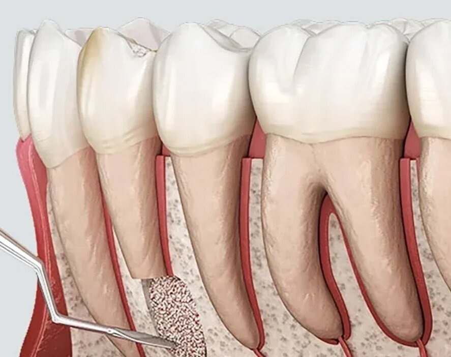 Резекция верхушки корня