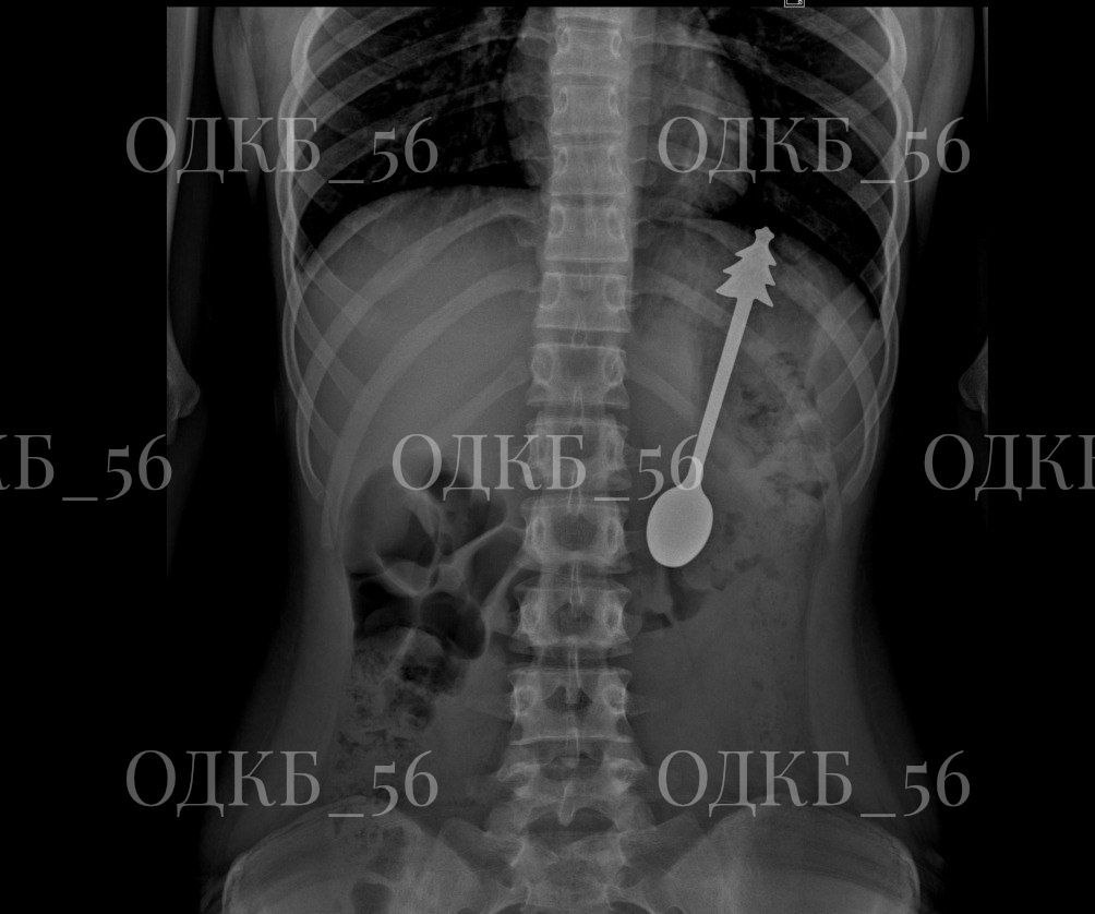    В Оренбурге ребенок проглотил 14-сантиметровую металлическую ложку