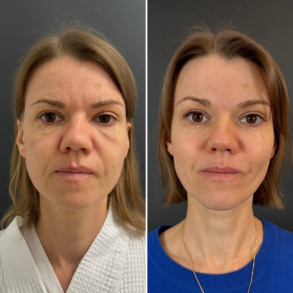 Эндоскопическая подтяжка верхних 2/3 лица: слева- до операции, справа- через 6 месяцев после операции. Хирург Остринская Т. В.