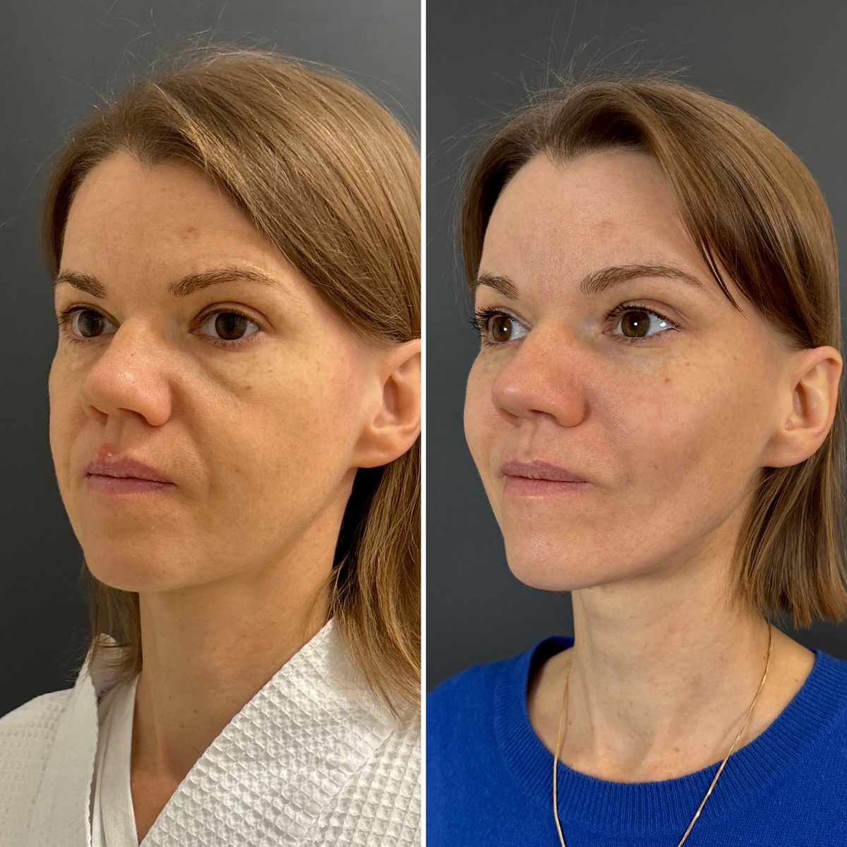Эндоскопическая подтяжка верхних 2/3 лица: слева- до операции, справа- через 6 месяцев после операции. Хирург Остринская Т. В.