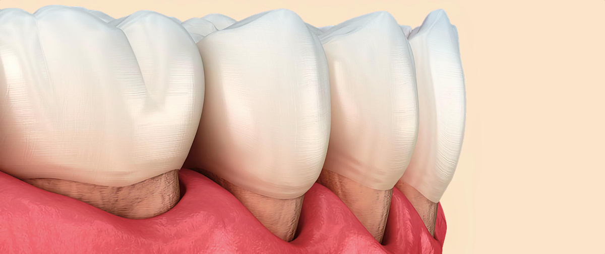 Причины и последствия рецессии десны