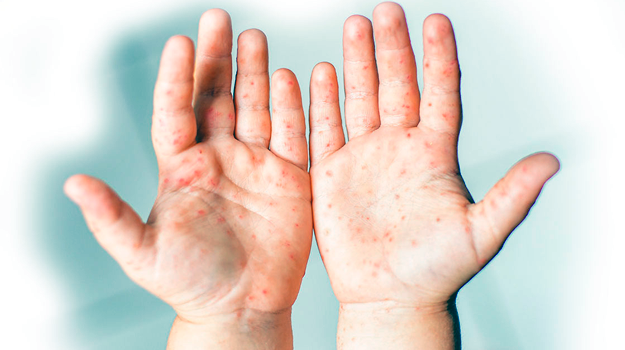    Энтеровирус проявляется по-разному: от сыпи до симптомов ангины. Фото: Пресс-служба Роспотребнадзора