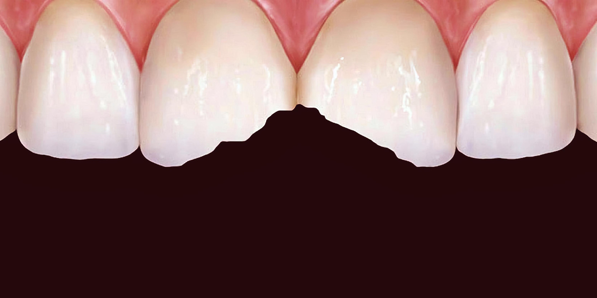 Причины крошения зубов