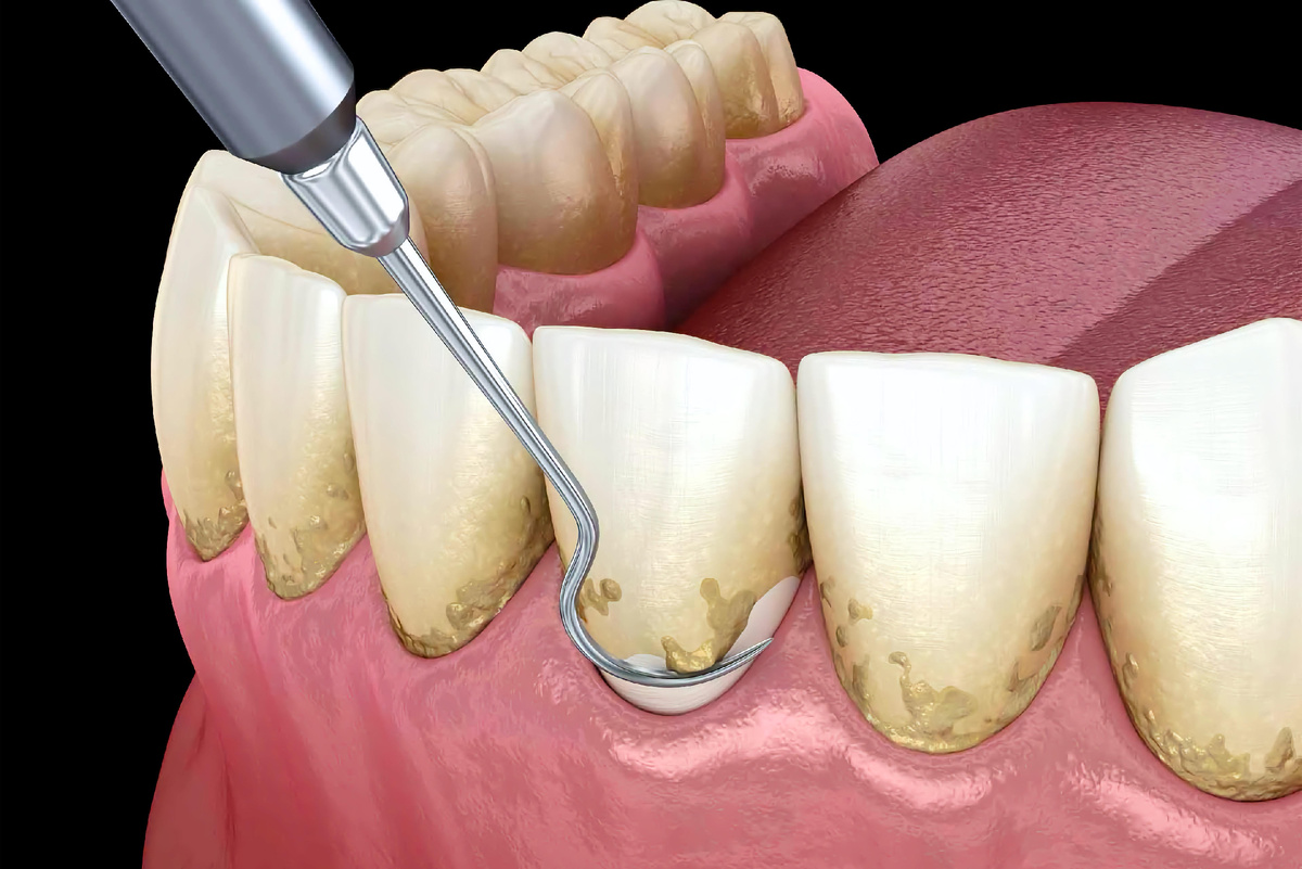 Разница между налетом и зубным камнем