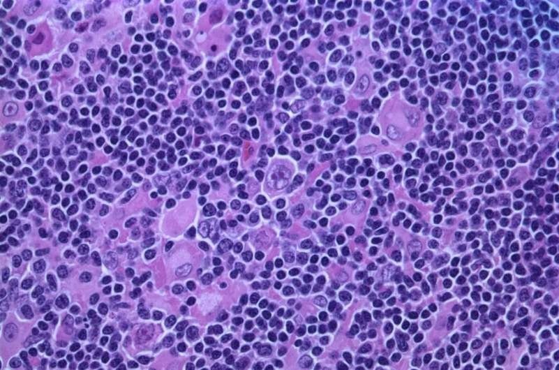    Лимфома Ходжкина с преобладанием узловых лимфоцитов (вид сверху) Автор: Габриэль Капонетти, Википедия/CC BY-SA 3.0