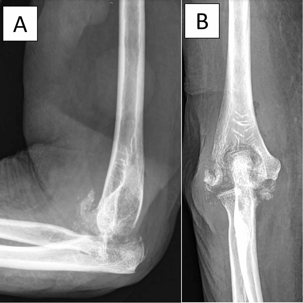 Разрушение кости при туберкулезном артрите.