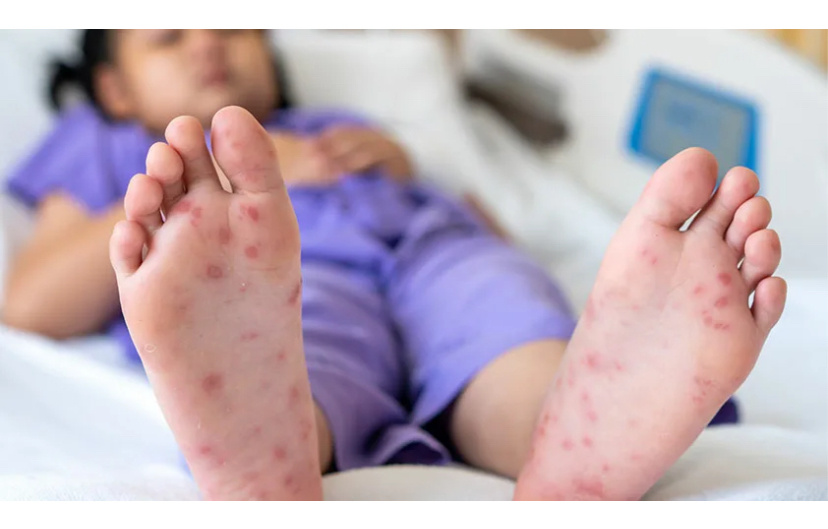 Характерная локализация сыпи при вирусе Коксаки