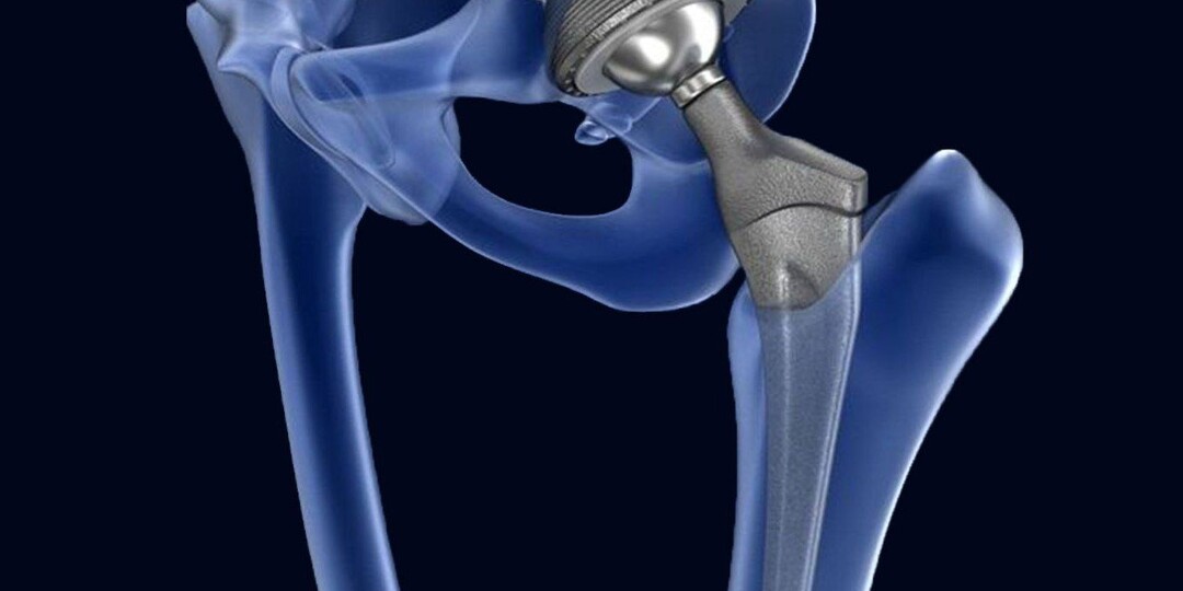 Новая жизнь после замены сустава: как вернуться к движению без страха и ошибок