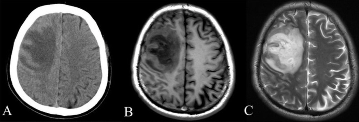КТ слева и МРТ (2 скана) справа