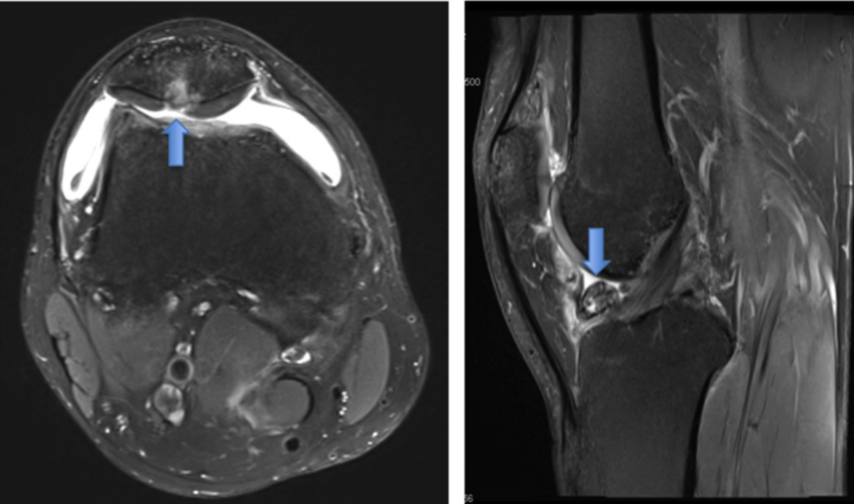 на МРТ детально видны повреждения хряща и хондромное тело в полости сустава