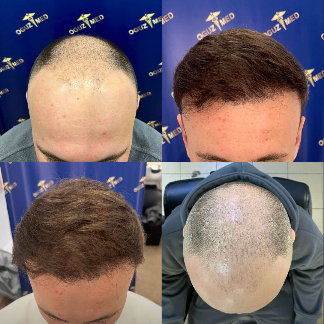 Изображение: Кейс OguzMed, «До» и «После» пересадки волос