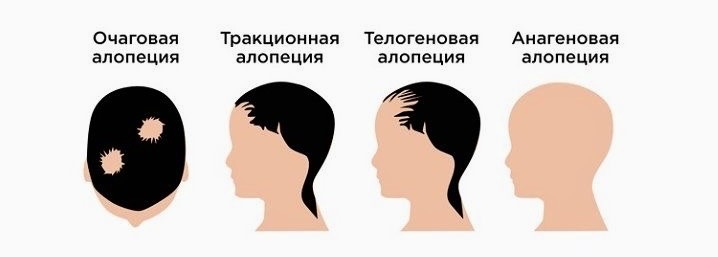 Изображение: виды алопеции