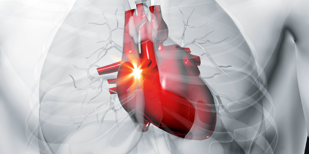 Стенокардия: когда сердце говорит «хватит»