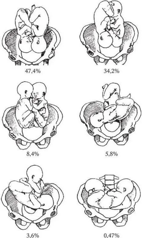 Страничка из справочника акушерки. Какие страшные книжки автору читать доводилось в 17 лет... 🧐До тётушкиной библиотеки руки дорвались. Зато автор точно знала, как вести себя при родах😂😂😂