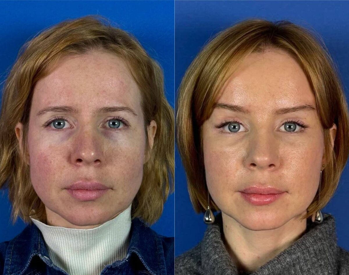 Моей пациентке 44 года! На фото три месяца после эндоскопической подтяжки лобно-височной зоны и средней трети лица