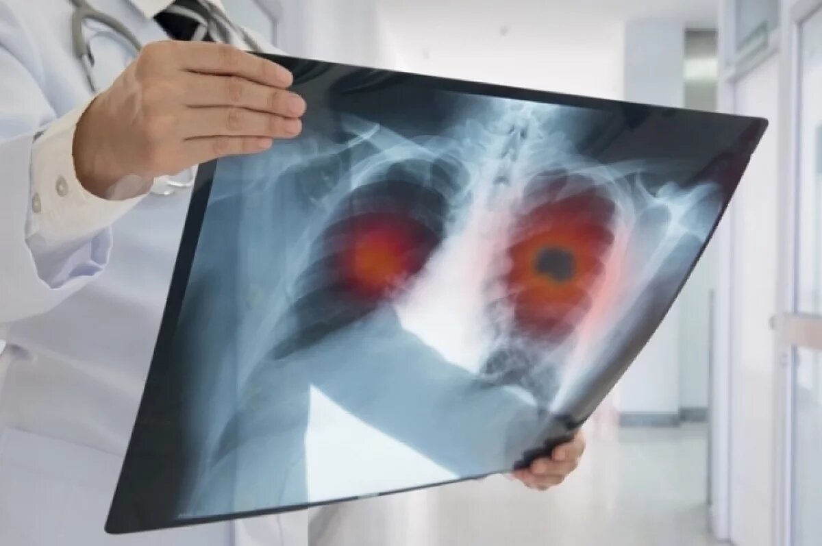    Врачи рассказали о тесте, который может помочь выявить рак легких