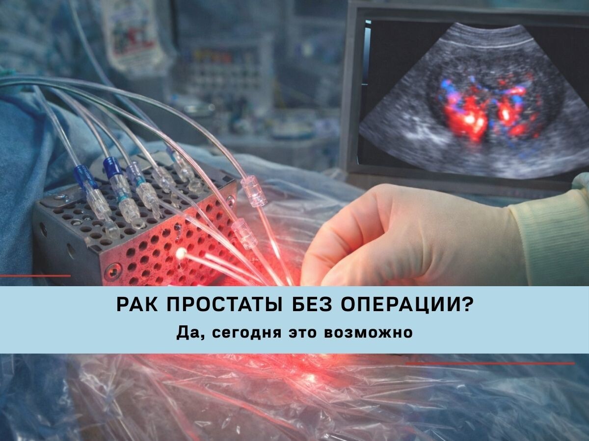 Фотодинамическая терапия — современный фокальный метод лечения рака простаты, позволяющий разрушать опухоль без удаления органа.
