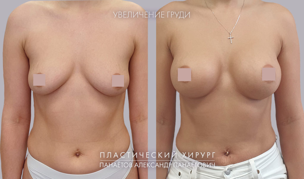Маммопластика: работа пластического хирурга А.П.Панаетова