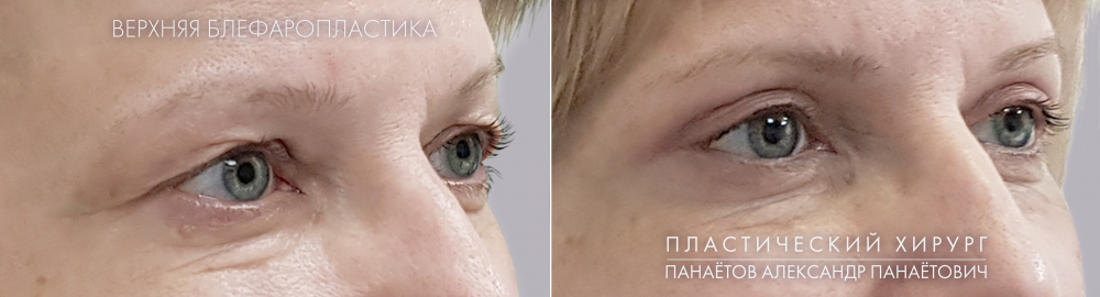 Верхняя блефаропластика: работа пластического хирурга А.П.Панаетова