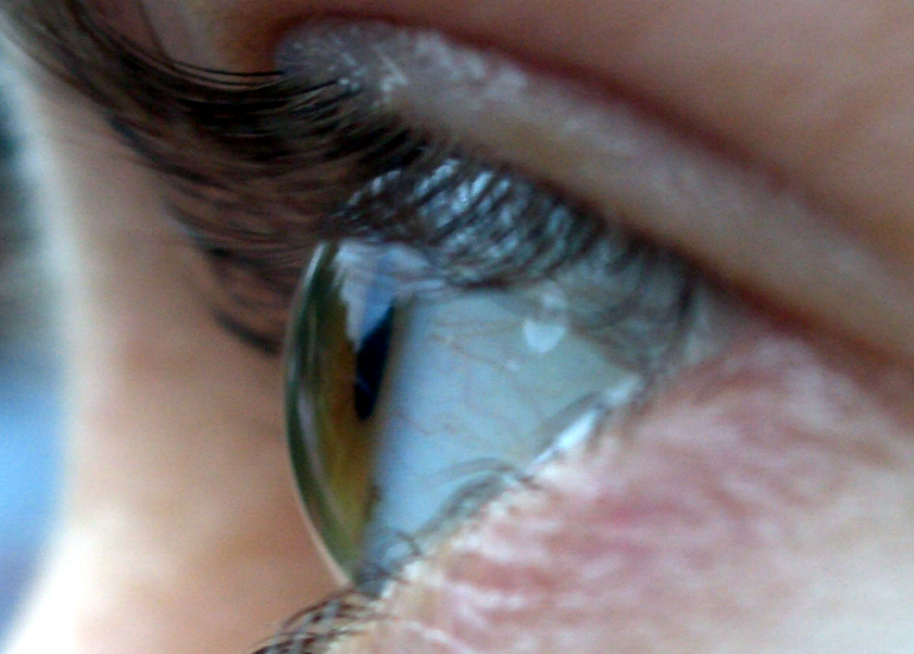 Линза роговицы