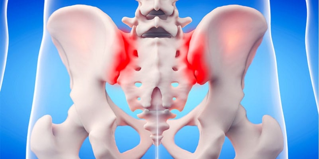 Сакроилиит. Или почему бывает остеохондроз не как у всех?