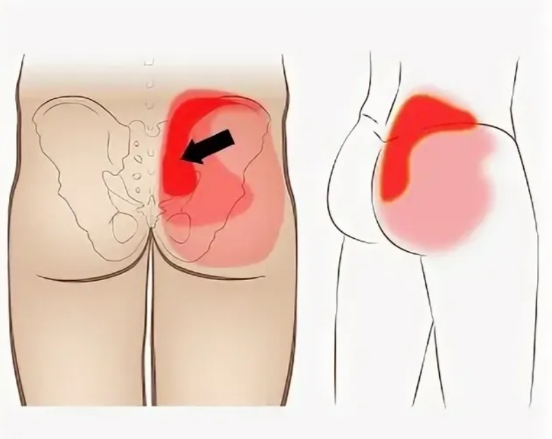 Типичная локализация болей