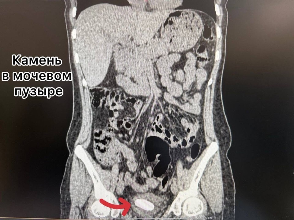    Камень из мочевого пузыря удаляли лазером. Фото: Тысячекоечная больница Владивостока