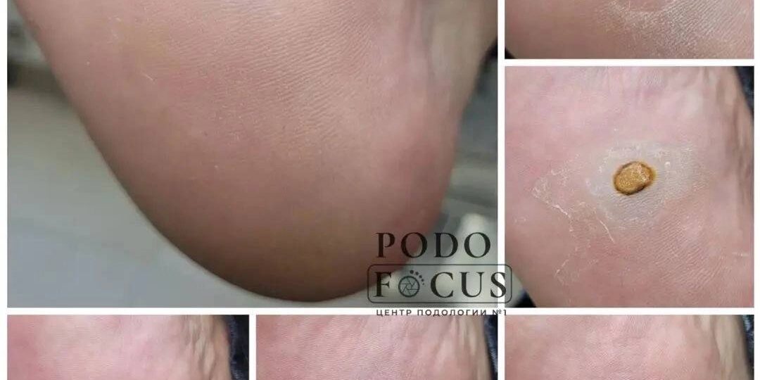 Бородавки: что нужно знать?