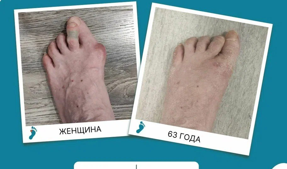 Можно ли исправить молоткообразный второй палец, не трогая большой?