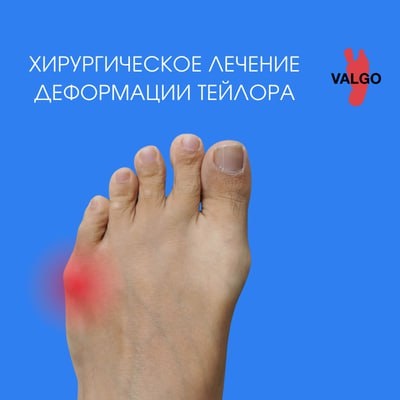 Варусная деформация пятого пальца стопы: когда «шишка» на мизинце реальная проблема