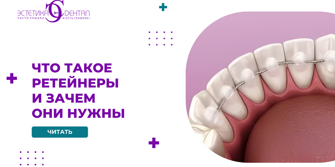 Что такое ретейнеры и зачем они нужны после ортодонтического лечения
