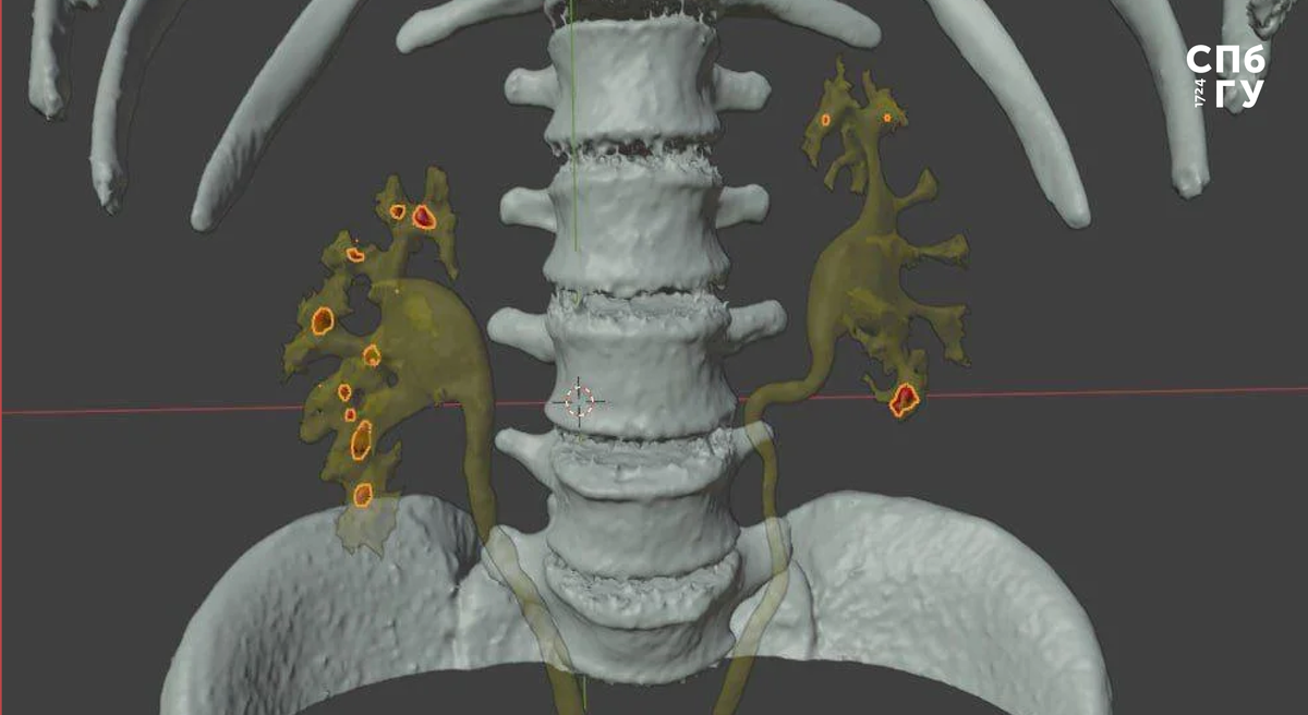 Смешанная или дополненная реальность — вспомогательный инструмент для быстрой ориентации хирургов. Изображение предоставлено Александром Петровым
