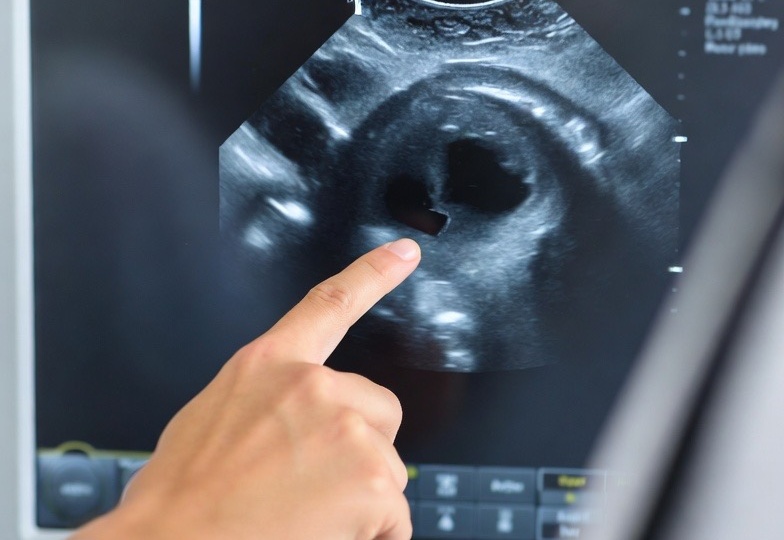 УЗИ сосудов показало бляшки: что это значит и почему это важно?