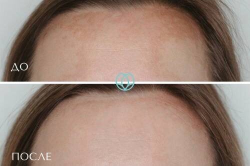 Результат лечения пигментации за 4 процедуры