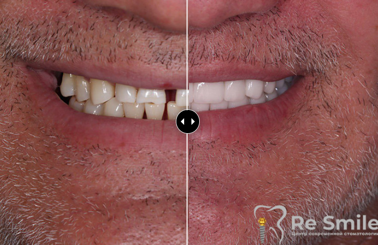 Пациент обратился с жалобами на частичное отсутствие зубов в боковых отделах и неудовлетворительную эстетику фронтальной группы зубов.

Проведена дентальная имплантация в области жевательных зубов с последующим протезированием циркониевыми мостовидными протезами. На фронтальных зубах и премолярах выполнены прямые керамические реставрации (технология «E-max»).