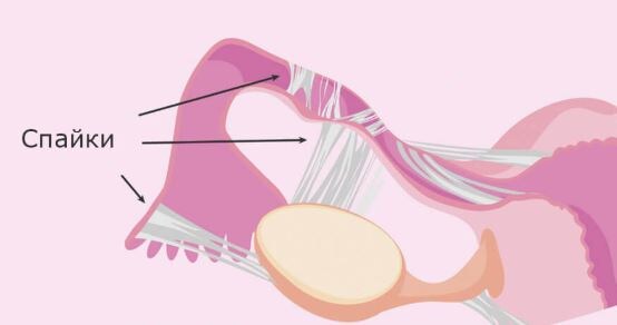 Спайки в малом тазу